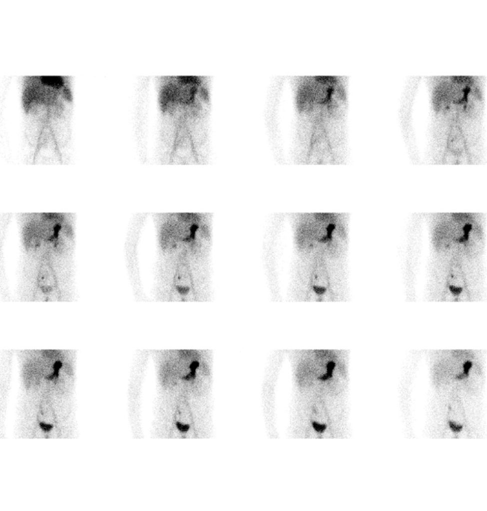 Scintigraphie du diverticule de Meckel